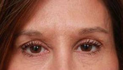 Eyelid Lift Before & After Gallery - Patient 149233 - Image 2 - Scott Chapin, MD