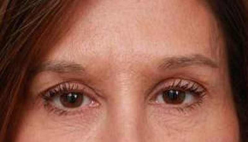 Eyelid Lift Before & After Gallery - Patient 149233 - Image 2 - Scott Chapin, MD