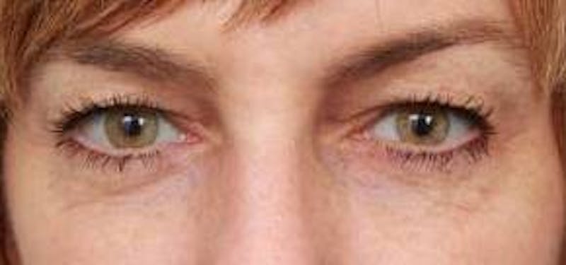 Eyelid Lift Before & After Gallery - Patient 549424 - Image 1 - Scott Chapin, MD