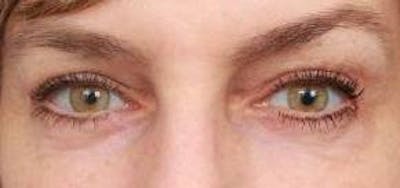Eyelid Lift Before & After Gallery - Patient 549424 - Image 2 - Scott Chapin, MD