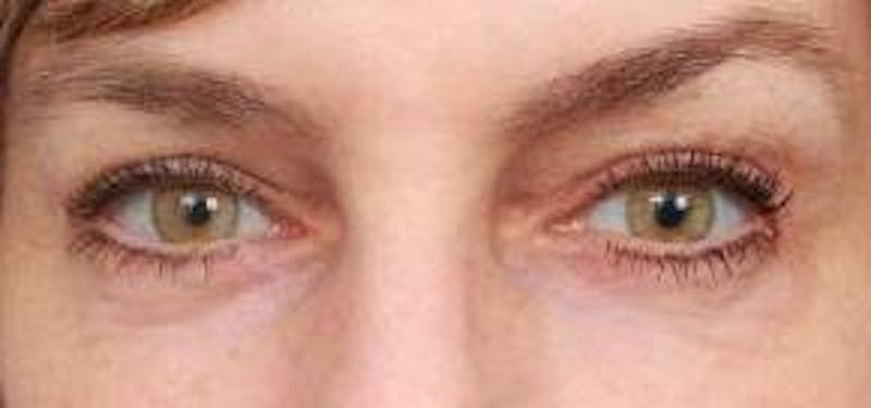 Eyelid Lift Before & After Gallery - Patient 549424 - Image 2 - Scott Chapin, MD