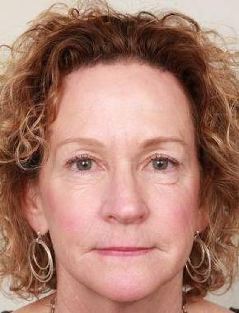 Brow Lift Before & After Gallery - Patient 155180 - Image 2 - Scott Chapin, MD