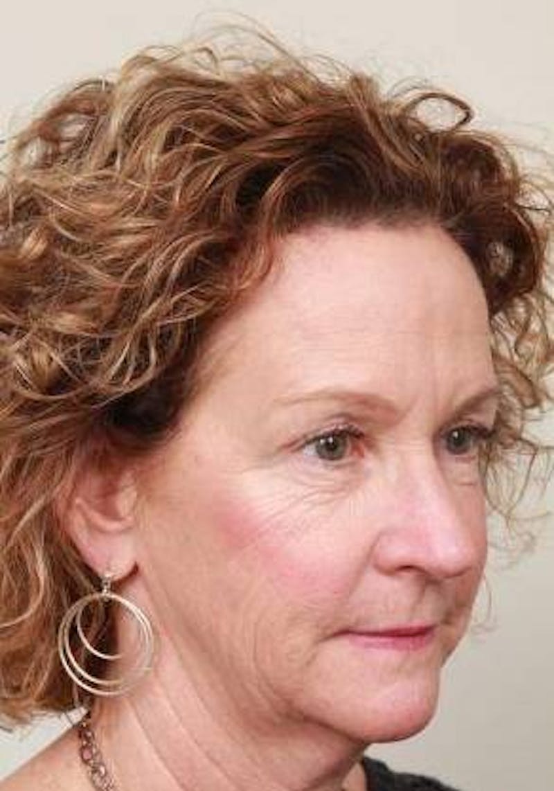 Brow Lift Before & After Gallery - Patient 155180 - Image 4 - Scott Chapin, MD