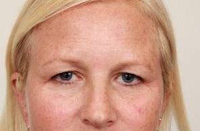 Brow Lift Before & After Gallery - Patient 408309 - Image 1 - Scott Chapin, MD