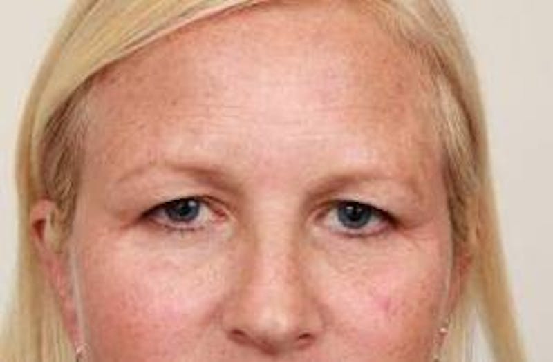 Brow Lift Before & After Gallery - Patient 408309 - Image 1 - Scott Chapin, MD
