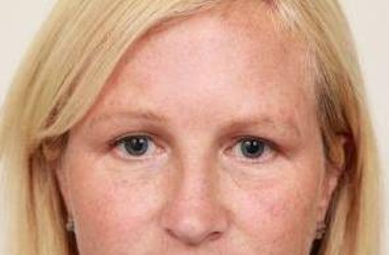 Brow Lift Before & After Gallery - Patient 408309 - Image 2 - Scott Chapin, MD