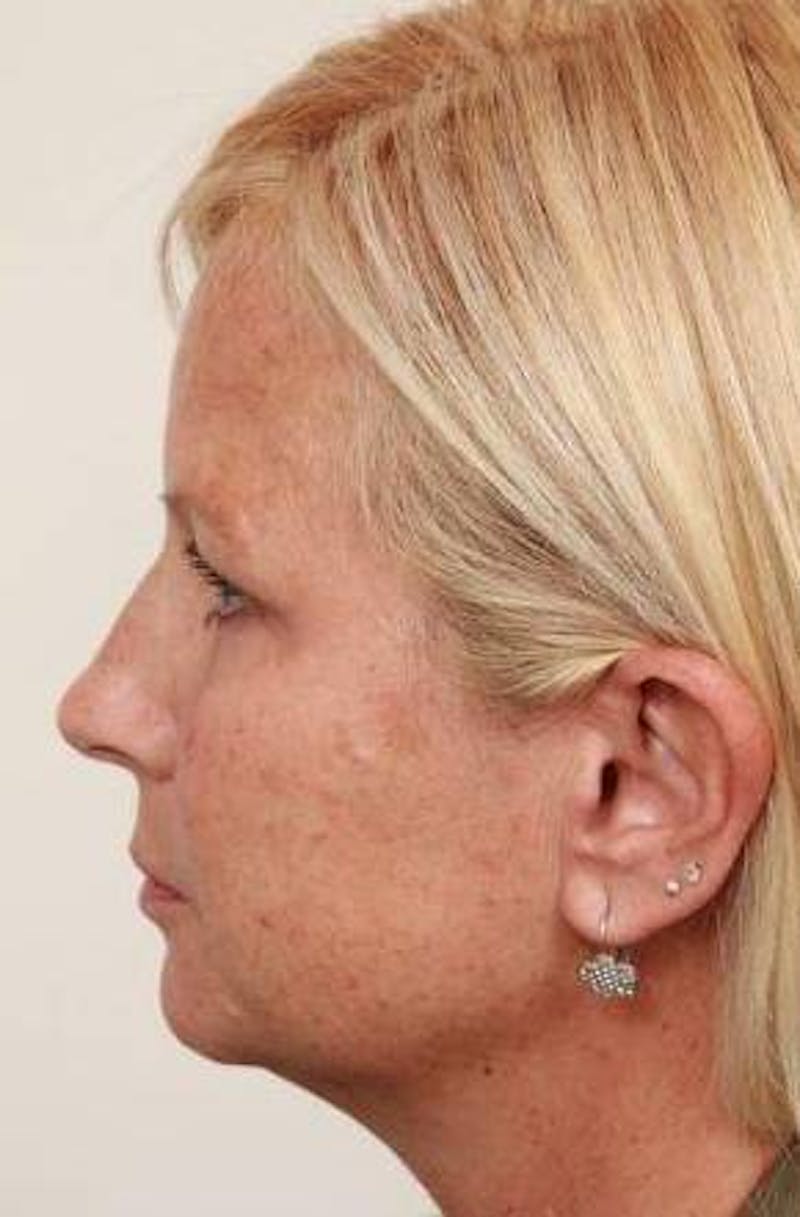 Brow Lift Before & After Gallery - Patient 408309 - Image 3 - Scott Chapin, MD