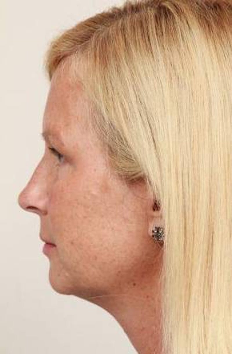 Brow Lift Before & After Gallery - Patient 408309 - Image 4 - Scott Chapin, MD