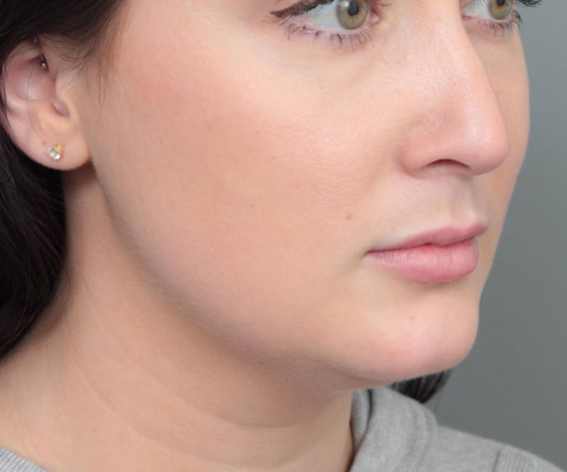 Neck Contouring Before & After Gallery - Patient 719273 - Image 1 - Scott Chapin, MD