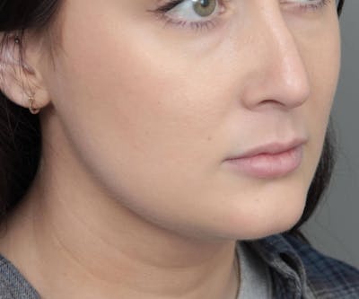 Neck Contouring Before & After Gallery - Patient 719273 - Image 2 - Scott Chapin, MD