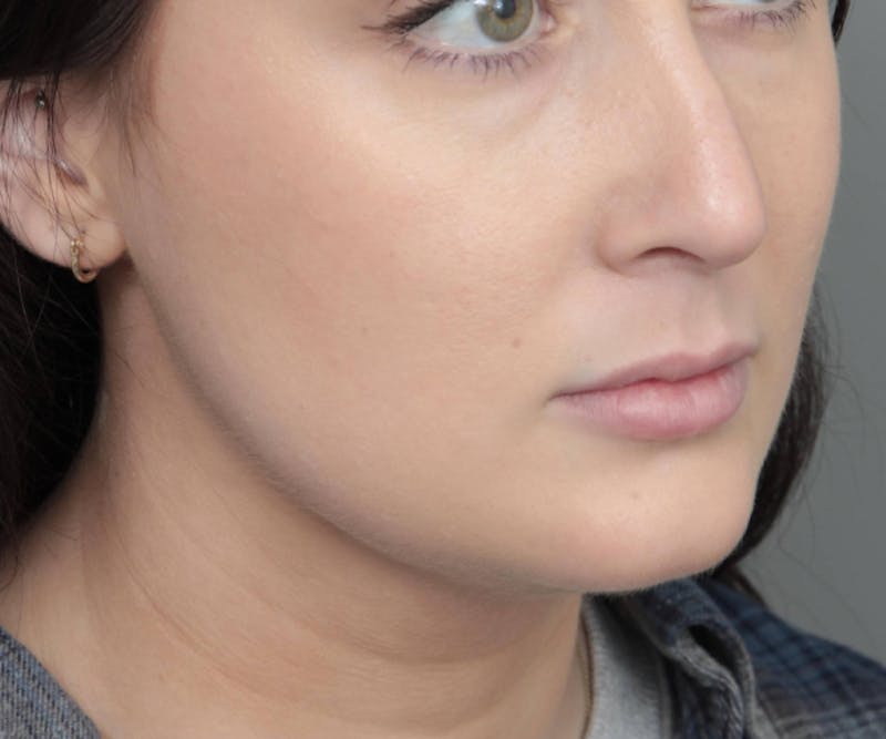 Neck Contouring Before & After Gallery - Patient 719273 - Image 2 - Scott Chapin, MD