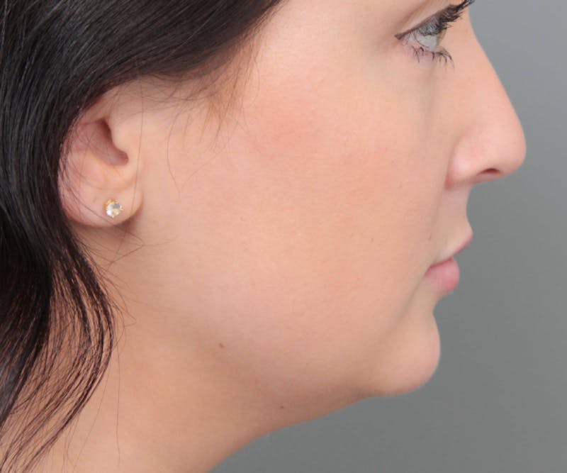Neck Contouring Before & After Gallery - Patient 719273 - Image 3 - Scott Chapin, MD
