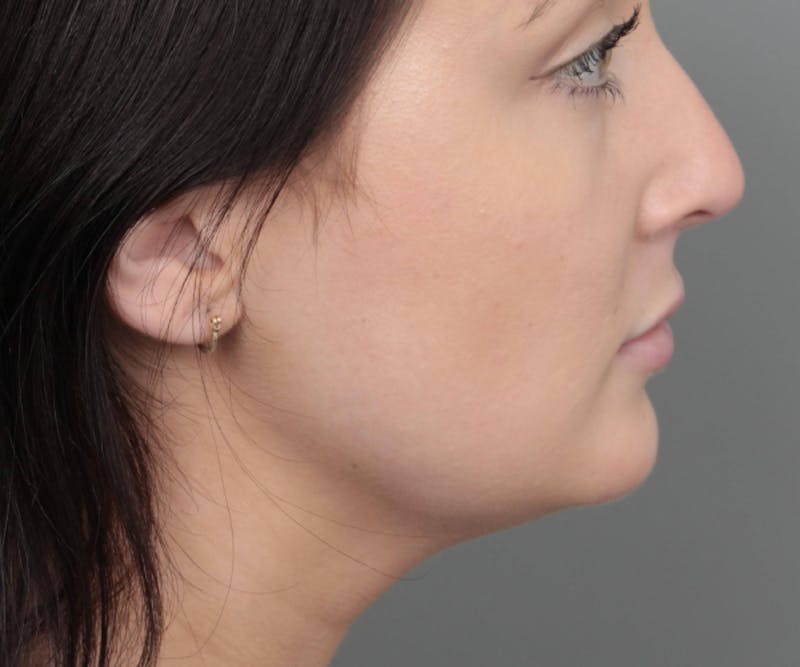 Neck Contouring Before & After Gallery - Patient 719273 - Image 4 - Scott Chapin, MD