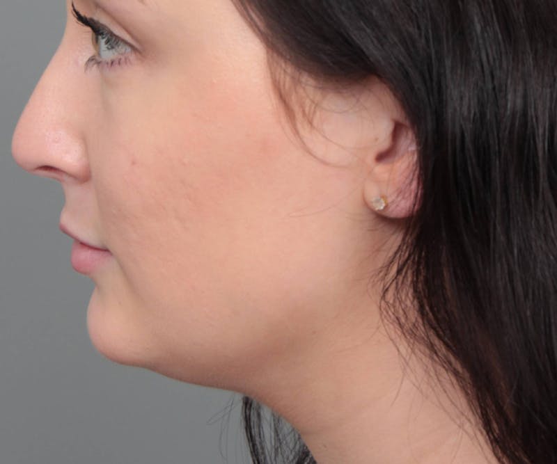 Neck Contouring Before & After Gallery - Patient 719273 - Image 5 - Scott Chapin, MD