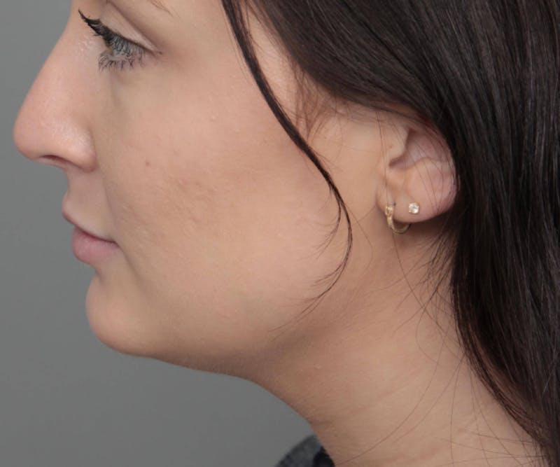Neck Contouring Before & After Gallery - Patient 719273 - Image 6 - Scott Chapin, MD