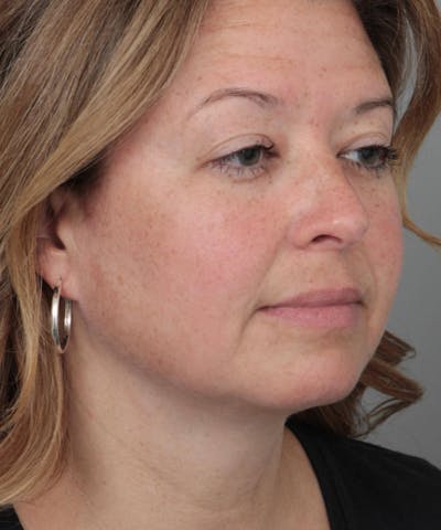 Neck Contouring Before & After Gallery - Patient 240099 - Image 2 - Scott Chapin, MD