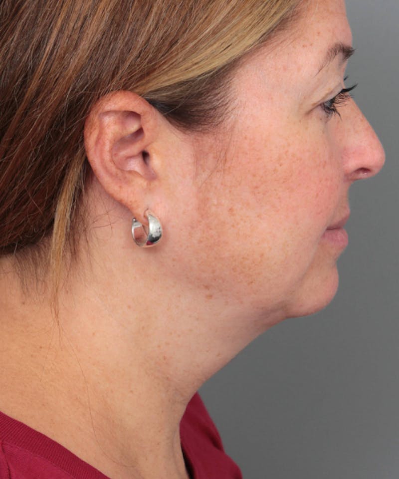 Neck Contouring Before & After Gallery - Patient 240099 - Image 3 - Scott Chapin, MD