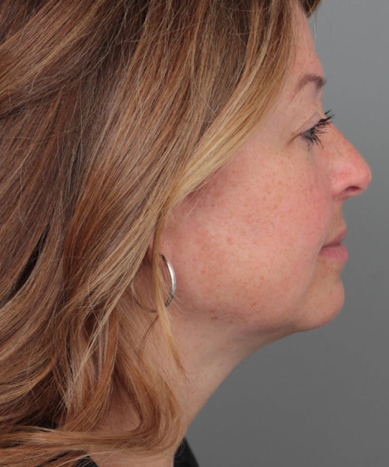 Neck Contouring Before & After Gallery - Patient 240099 - Image 4 - Scott Chapin, MD