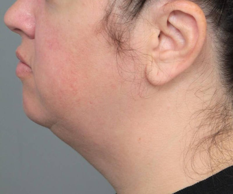 Neck Contouring Before & After Gallery - Patient 160545 - Image 1 - Scott Chapin, MD