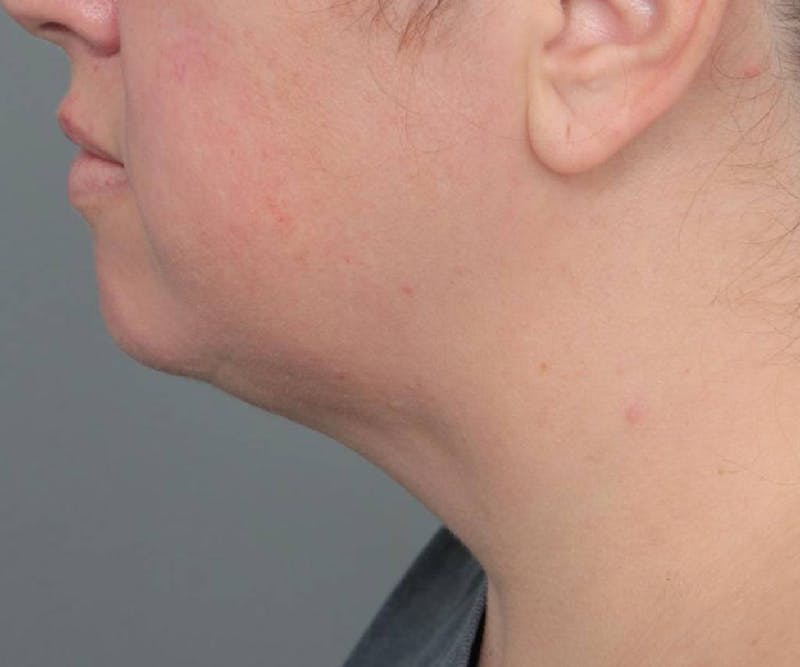 Neck Contouring Before & After Gallery - Patient 160545 - Image 2 - Scott Chapin, MD