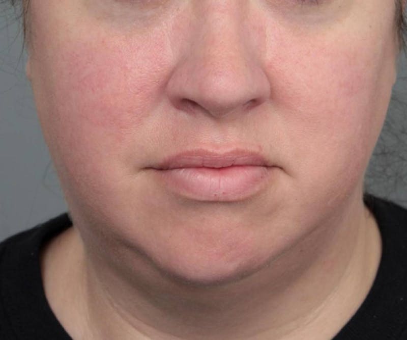 Neck Contouring Before & After Gallery - Patient 160545 - Image 3 - Scott Chapin, MD