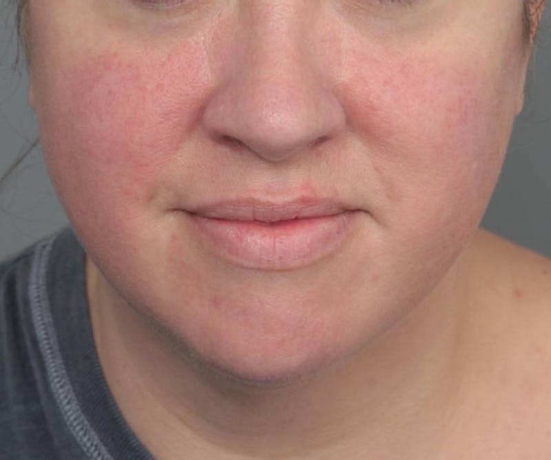 Neck Contouring Before & After Gallery - Patient 160545 - Image 4 - Scott Chapin, MD