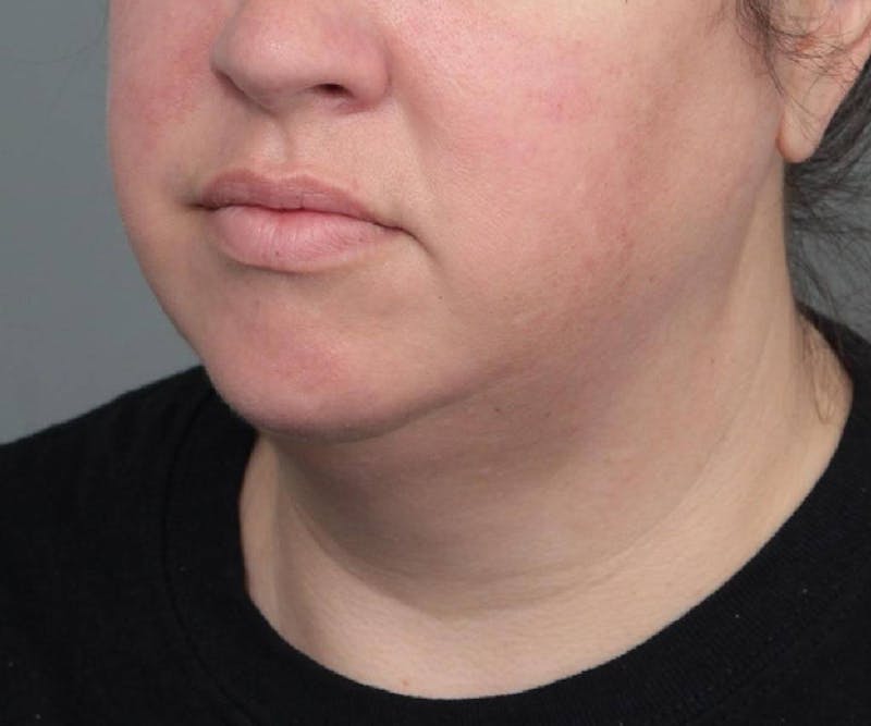 Neck Contouring Before & After Gallery - Patient 160545 - Image 5 - Scott Chapin, MD