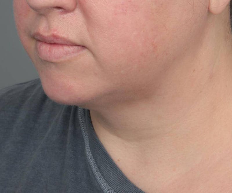 Neck Contouring Before & After Gallery - Patient 160545 - Image 6 - Scott Chapin, MD