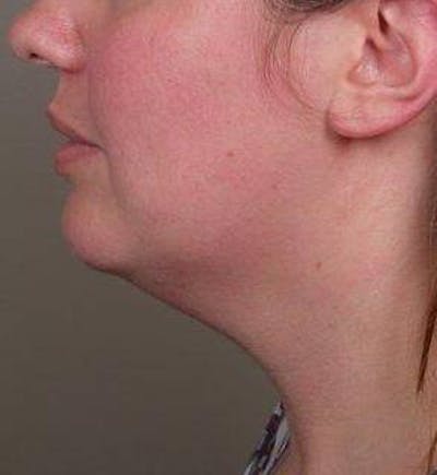 Neck Contouring Before & After Gallery - Patient 323627 - Image 1 - Scott Chapin, MD