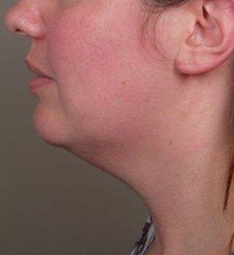Neck Contouring Before & After Gallery - Patient 323627 - Image 1 - Scott Chapin, MD