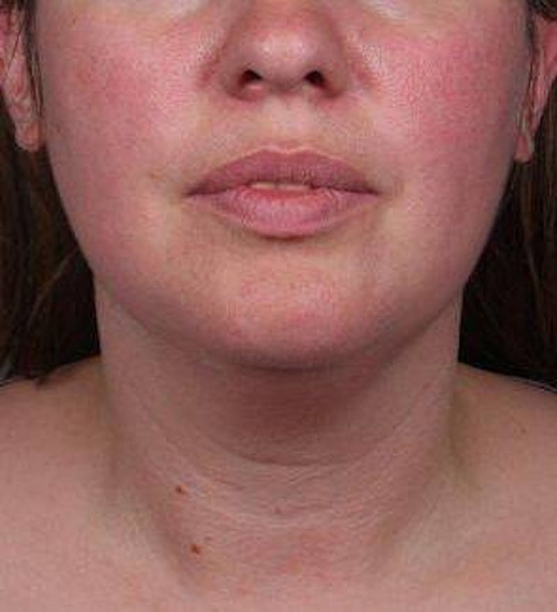 Neck Contouring Before & After Gallery - Patient 323627 - Image 3 - Scott Chapin, MD