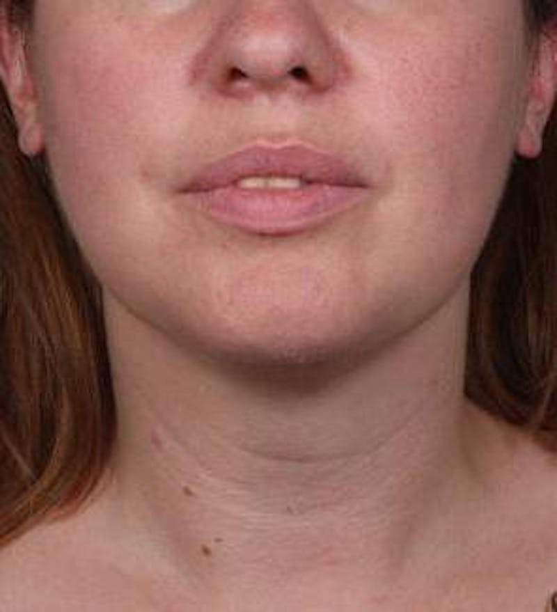 Neck Contouring Before & After Gallery - Patient 323627 - Image 4 - Scott Chapin, MD