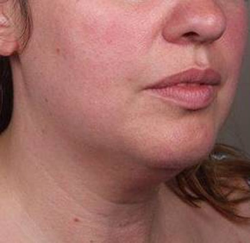 Neck Contouring Before & After Gallery - Patient 323627 - Image 5 - Scott Chapin, MD