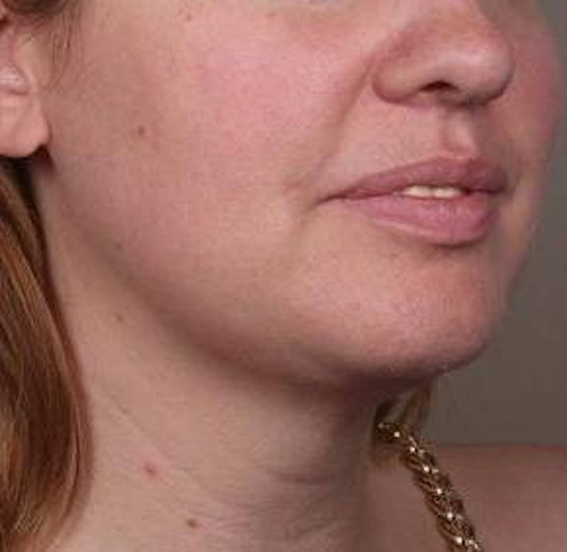 Neck Contouring Before & After Gallery - Patient 323627 - Image 6 - Scott Chapin, MD