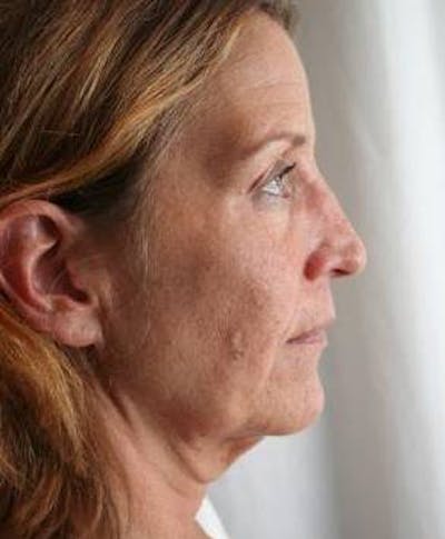 Neck Contouring Before & After Gallery - Patient 241199 - Image 1 - Scott Chapin, MD