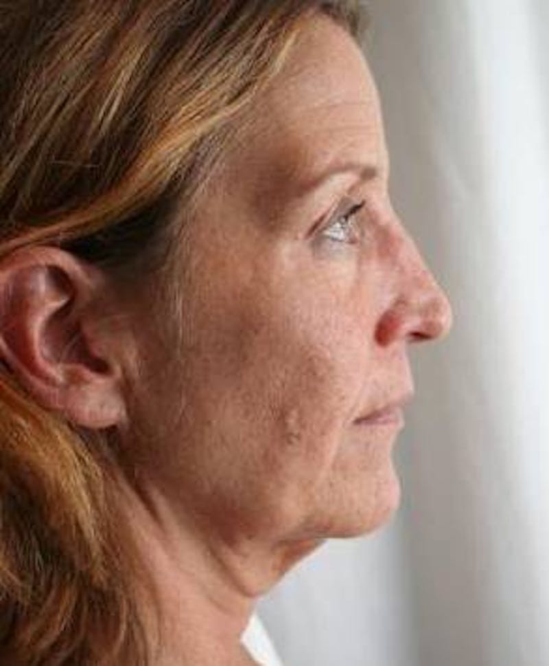 Neck Contouring Before & After Gallery - Patient 241199 - Image 1 - Scott Chapin, MD