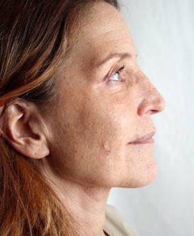 Neck Contouring Before & After Gallery - Patient 241199 - Image 2 - Scott Chapin, MD