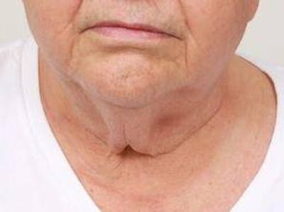 Neck Contouring Before & After Gallery - Patient 792063 - Image 1 - Scott Chapin, MD