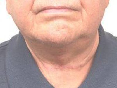 Neck Contouring Before & After Gallery - Patient 792063 - Image 2 - Scott Chapin, MD