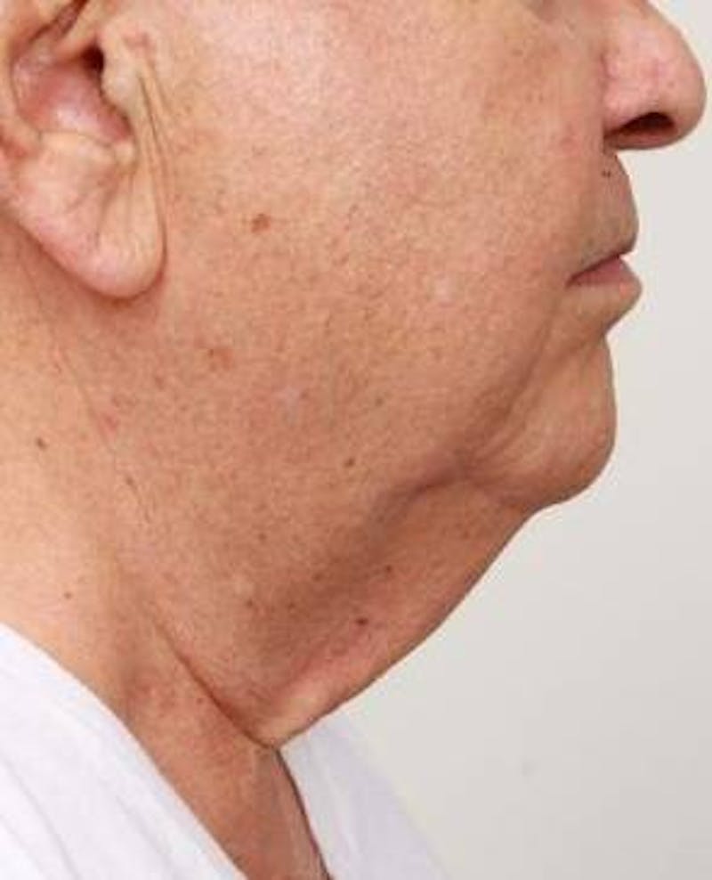 Neck Contouring Before & After Gallery - Patient 792063 - Image 3 - Scott Chapin, MD