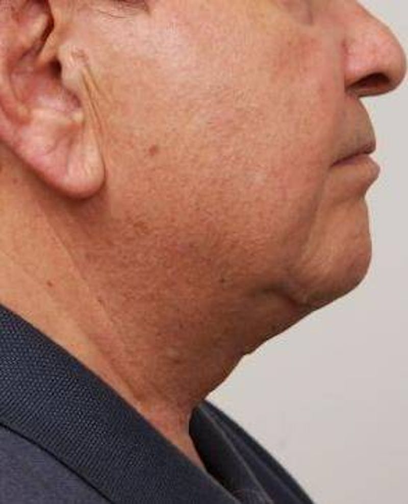 Neck Contouring Before & After Gallery - Patient 792063 - Image 4 - Scott Chapin, MD