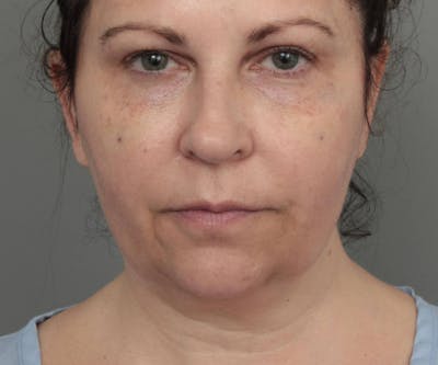 Neck Contouring Before & After Gallery - Patient 307513 - Image 1 - Scott Chapin, MD