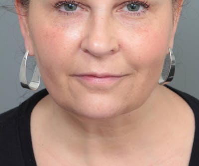 Neck Contouring Before & After Gallery - Patient 307513 - Image 2 - Scott Chapin, MD