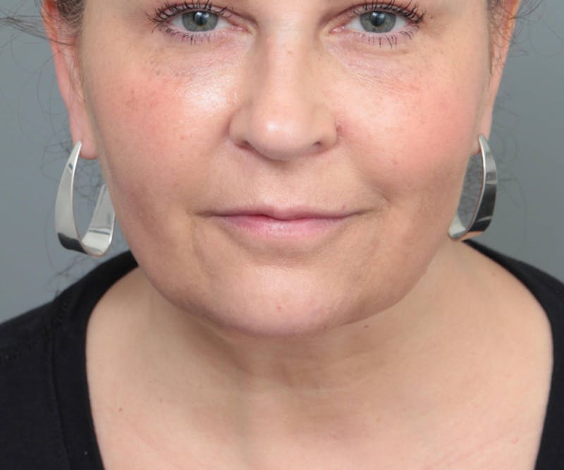 Neck Contouring Before & After Gallery - Patient 307513 - Image 2 - Scott Chapin, MD