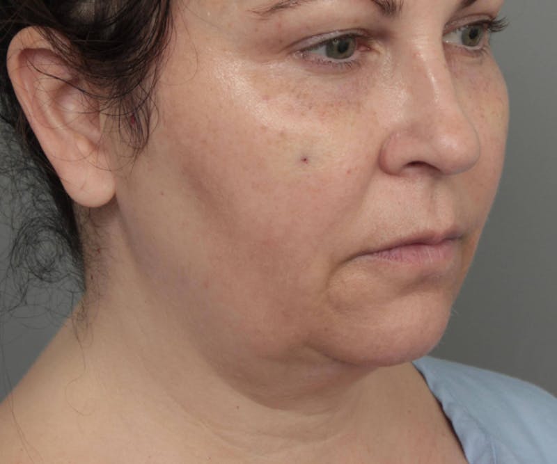 Neck Contouring Before & After Gallery - Patient 307513 - Image 3 - Scott Chapin, MD
