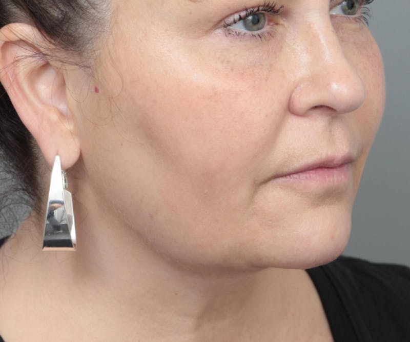 Neck Contouring Before & After Gallery - Patient 307513 - Image 4 - Scott Chapin, MD