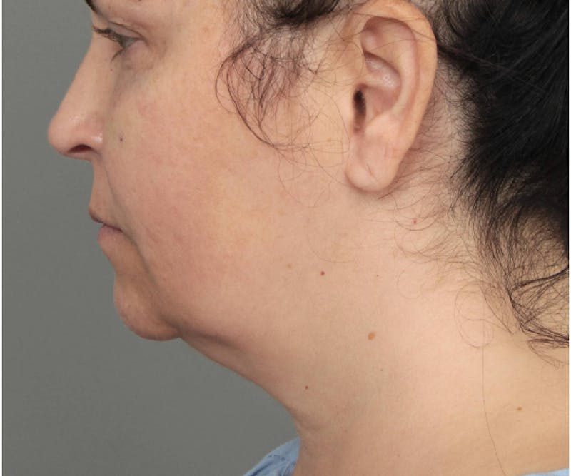 Neck Contouring Before & After Gallery - Patient 307513 - Image 5 - Scott Chapin, MD