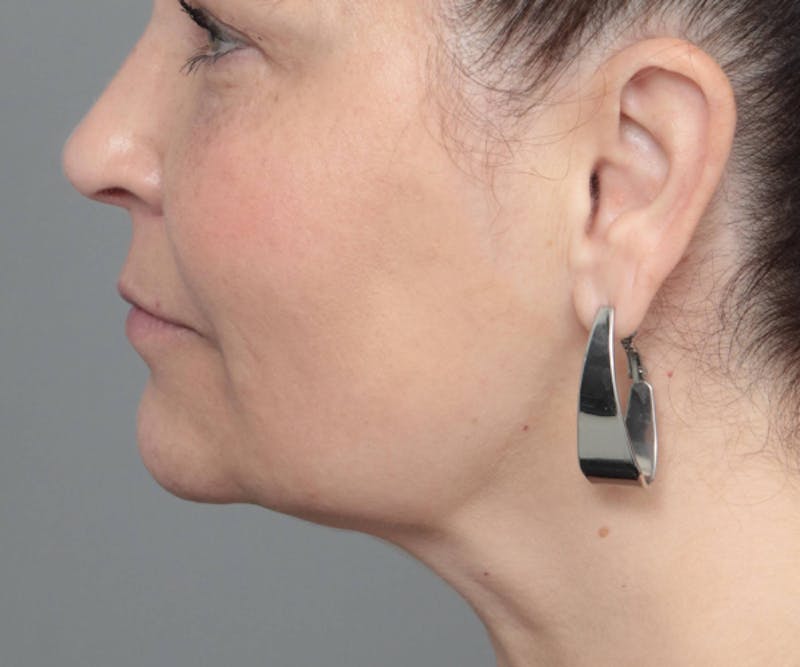 Neck Contouring Before & After Gallery - Patient 307513 - Image 6 - Scott Chapin, MD