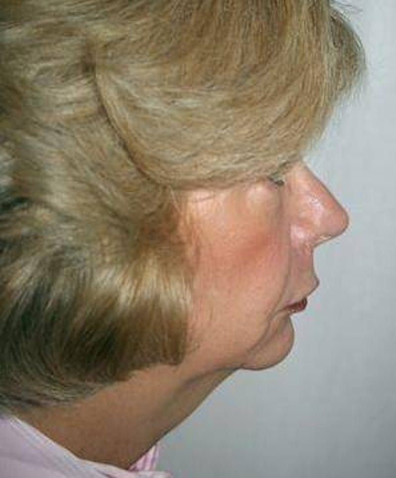 Facial Implants Before & After Gallery - Patient 279456 - Image 1 - Scott Chapin, MD