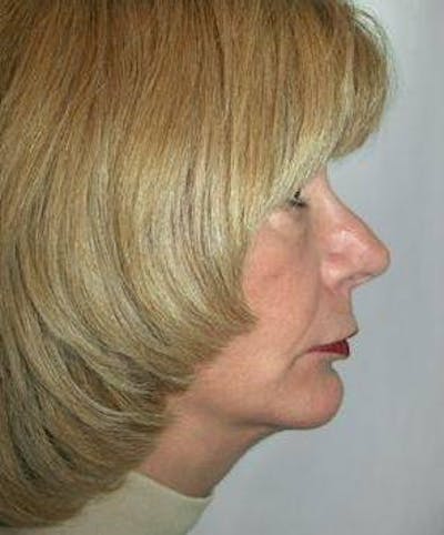Facial Implants Before & After Gallery - Patient 279456 - Image 2 - Scott Chapin, MD